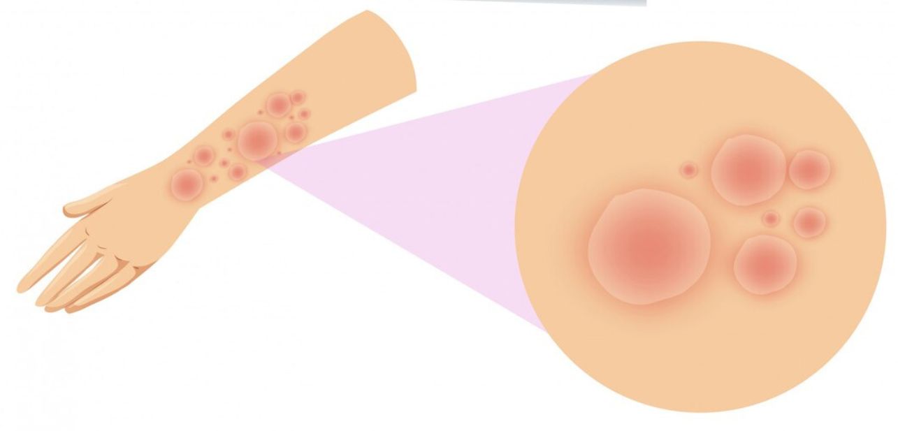 Suffering from Lichen Planus